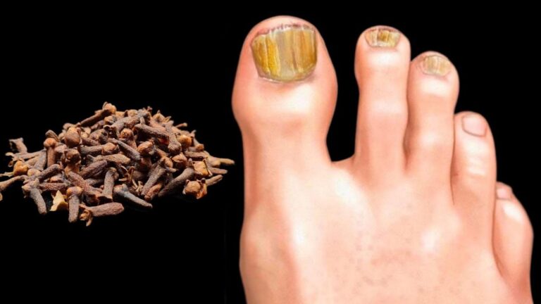 This simple remedy transforms nail health… uncover the secret power of cloves…