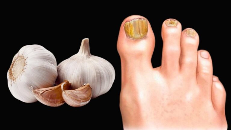 This simple remedy transforms nail health using garlic and everyday ingredients…