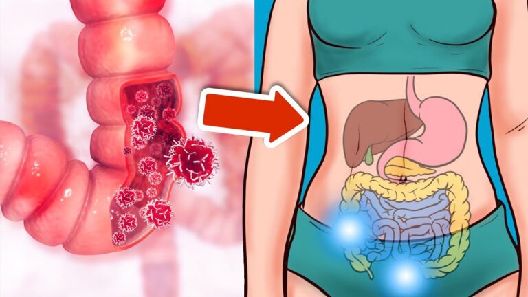 7 Early Warning Signs of Colon Cancer You Must Not Ignore!