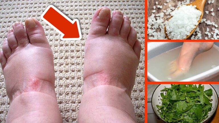 10 Effective Remedies to Reduce Swollen Feet Naturally and Quickly!