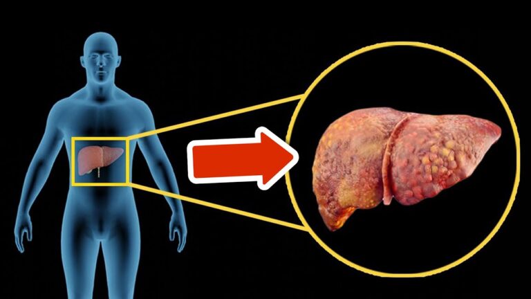 5 Signs of Liver Cirrhosis You Must Never Ignore to Stay Healthy!