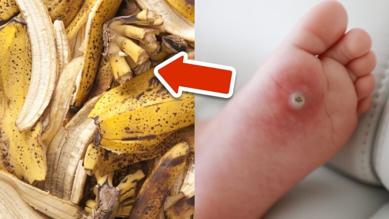 5 Simple Ways to Get Rid of Warts and Feel Confident Again!