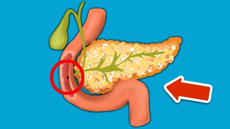 7 Warning Signs of Pancreatitis You Should Never Ignore! Discover the Truth Now!