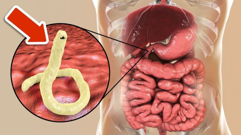 Eliminate Gut Parasites Fast with These 4 Easy Natural Remedies