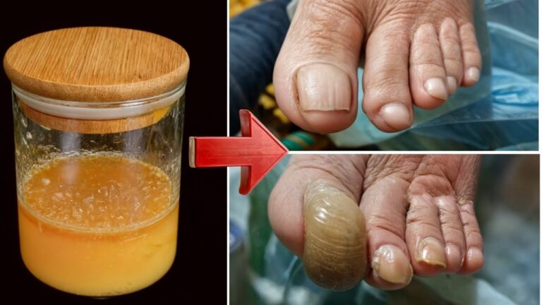 7 Easy Home Remedies for Beautiful, Healthy Nails Fungi-Free!